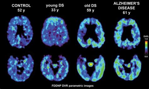 Brain Scan Identifies Patterns Of Plaques And Tangles In Adults With