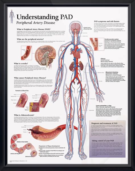 Understanding Pad Chart 22x28 Peripheral Artery Disease Medical