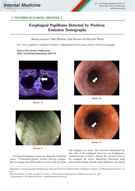 PDF Esophageal Papilloma Detected By Positron Emission Tomography