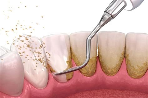 Periodontal Treatment In Surrey BC Pacific Highway Dental