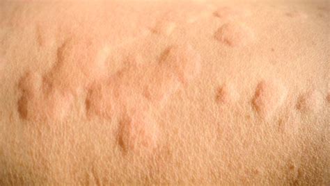 Common Causes Of Itchy Red Bumps On Skin The Best Porn Website