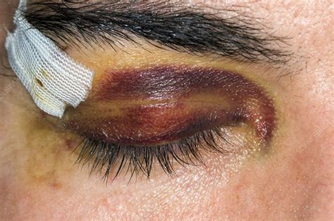 Black eye from a sport's injury - Stock Image - C008/3701 - Science