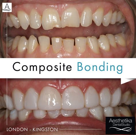 What Is Composite Dental Bonding Aesthetika Dental Studio