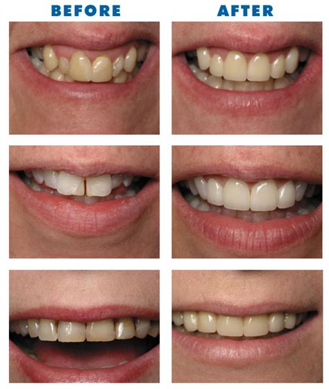 18 Photos Inspirational Veneers For Crooked Teeth