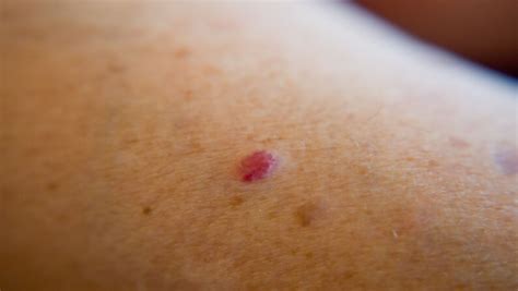 What Is Cherry Angioma Causes Symptoms Risk Factors And More Skin
