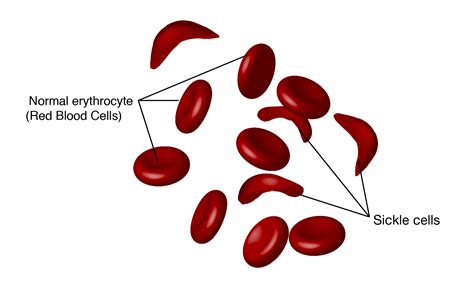 Anemia And Its Type Overall Science