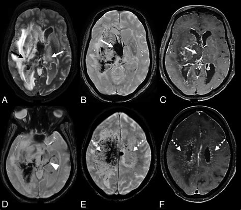 Atypical Deep Cerebral Vein Thrombosis With Hemorrhagic Venous