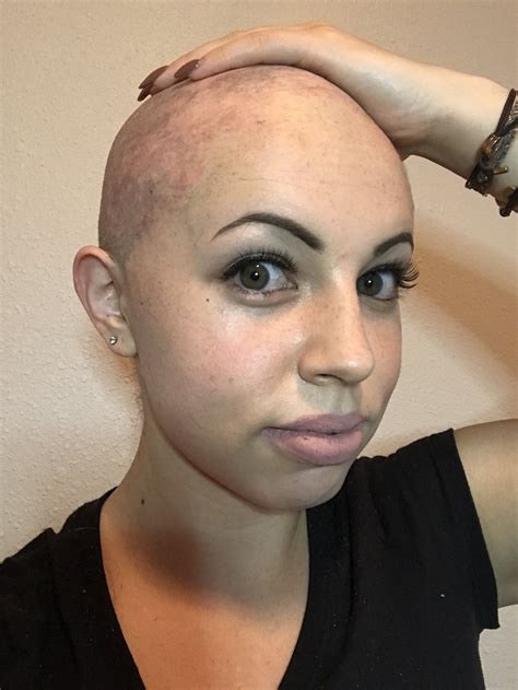 Alopecia Half Shaved Shaved Head Bald Look Exposure Therapy Shave