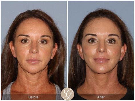 Neck Lift Before After Photos Patient Dr Kevin Sadati