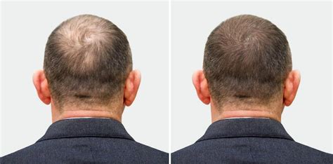 Hair Loss In Men Male Pattern Baldness