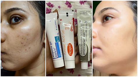 Dermatologist Recommended Best 3 Creams To Remove Pimple Marks Acne Scars Dark Spots Pih