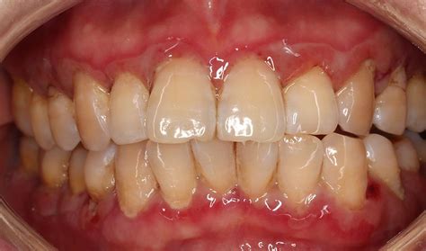 Erythema And Erosion On The Gingiva The Bmj