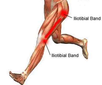 Iliotibial Band Syndrome IT Band Syndrome SAMARPAN PHYSIOTHERAPY
