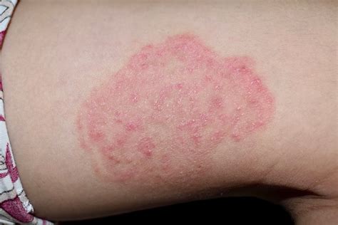Fungal Infections Of The Skin Tinea Capitis And Tinea Versicolor And Porn Sex Picture
