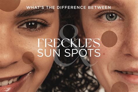 The Difference Between Freckles And Sun Spots Dr Natasha Cook Dr Natasha Cook Cosmeceuticals