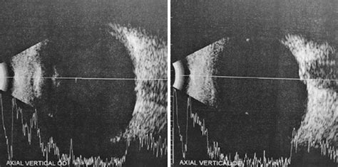 Scielo Brasil Coexistence Of Papilledema And Pseudopapilledema