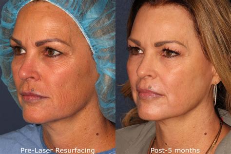 Fractional Resurfacing Laser By San Diego Dermatologists