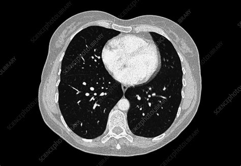 These scans use safe amounts of radiation to create detailed images, which can help your doctor to detect any. Normal lungs and heart, CT scan - Stock Image - C001/8066 ...