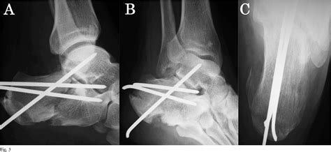 Figure 3 From Entrapment Of The Flexor Hallucis Longus Tendon By Direct