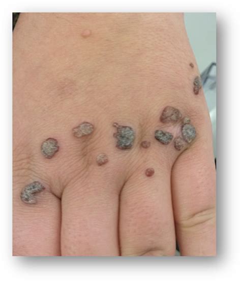 If you could get me out. The difference between skin tags and warts - Sterex
