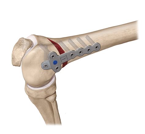Arthrex Osteotomie Des Distalen Femurs