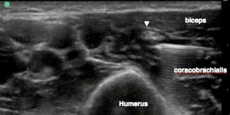 Ultrasound Guided Musculocutaneous Block — Highland Em Ultrasound