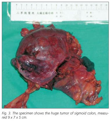 The sigmoid colon is the continuation of the descending colon. Neoplasias del colon sigmoide; Cáncer de Sigmoide; Cáncer ...