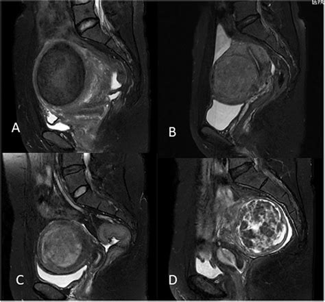 T2 Weighted Imaging Signal Intensity Of Uterine Fibroids A