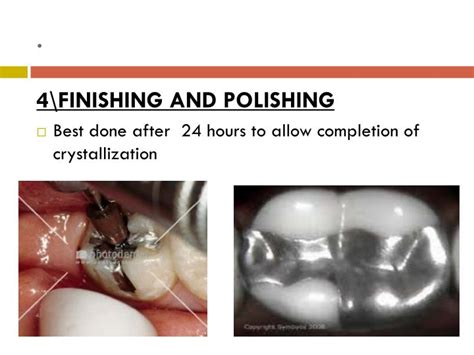 Ppt Dental Amalgam Powerpoint Presentation Id6299866