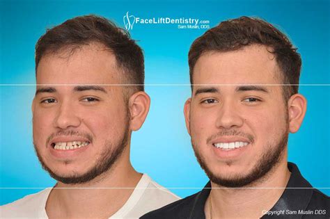 And this false belief could cause you to go years without seeking help. Before and After Photos: Underbite, Overbite, Open Bite