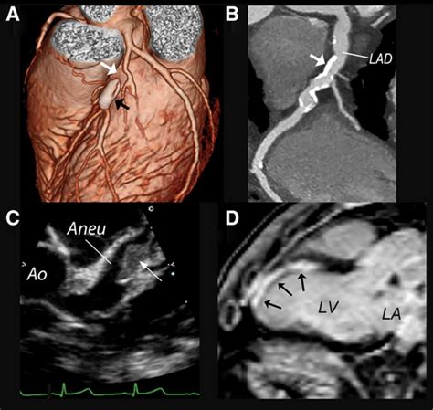 The Future Of Cardiovascular Imaging Circulation