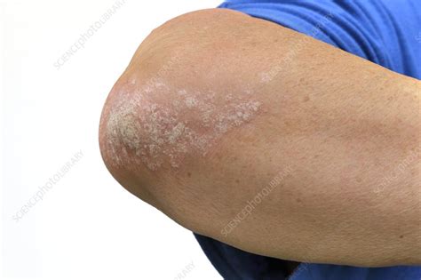 Psoriasis On The Elbow Stock Image C0151666 Science Photo Library