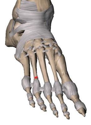 fractured 4th metatarsal