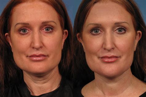 Laser Neck Lift Precision Tx Before And After Pictures Case 280