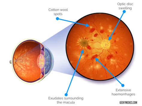 Fundoscopic Appearances Of Retinal Pathologies Geeky Medics