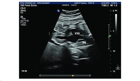 Fetal Lateral Ventricle Measurement Ultrasound