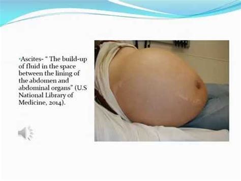 When you do have symptoms, they can remember primary liver cancer isn't common in the uk and these symptoms can be caused by other conditions. Cancer De Higado Etapa Final - SEONegativo.com