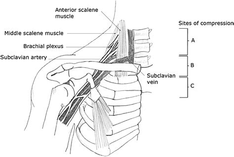 Thoracic Outlet Syndrome Part 1 Clinical Manifestations