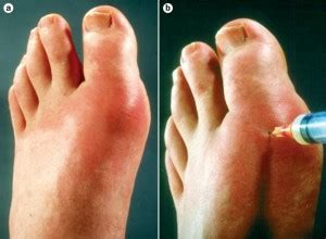 Am i healing from the urge of winning interesting games i'm willing to try, but will probably never find the time to actually play? Gout: What it Is, How it's Treated, and How to Prevent It ...