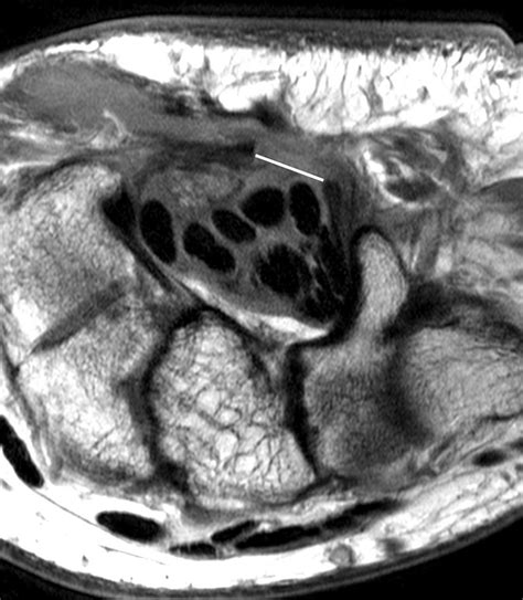 Mri Of The Carpal Tunnel 3 And 12 Months After Endoscopic Carpal Tunnel