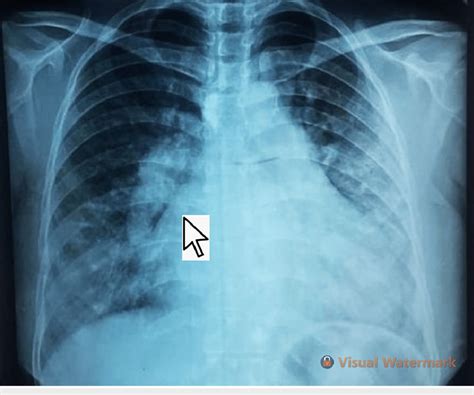 A Chest X Ray Posteroanterior Pa View With A Pointer Illustrating The