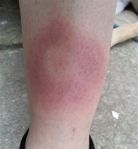Une maladie méconnue, bien que plus de 56 000 cas sont recensés en france.« Piqûre de tique : photos, symptômes, que faire