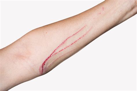 Cat Scratch Stock Photo Download Image Now Istock