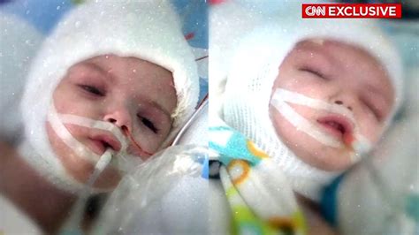 Separated Conjoined Twins Once Attached At Head Resting In Separate Beds