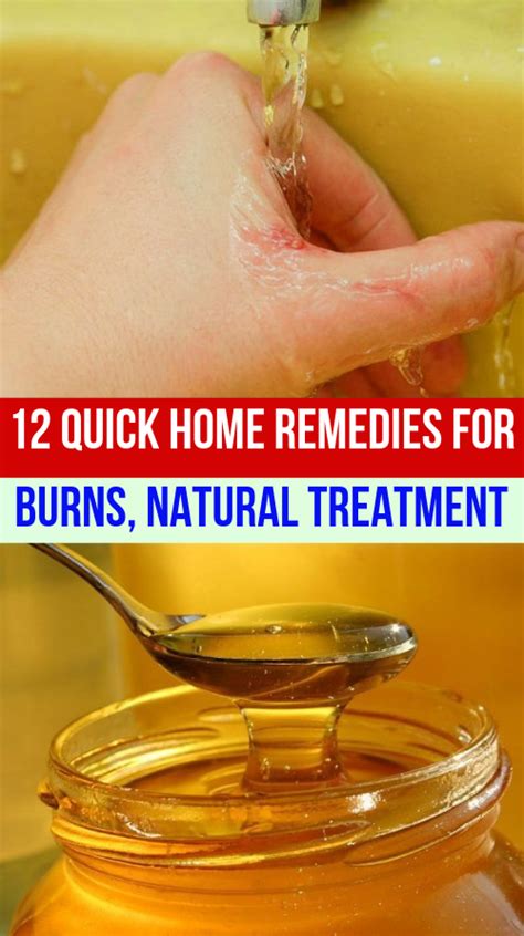 12 Quick Home Remedies For Burns Natural Treatment Webshealth