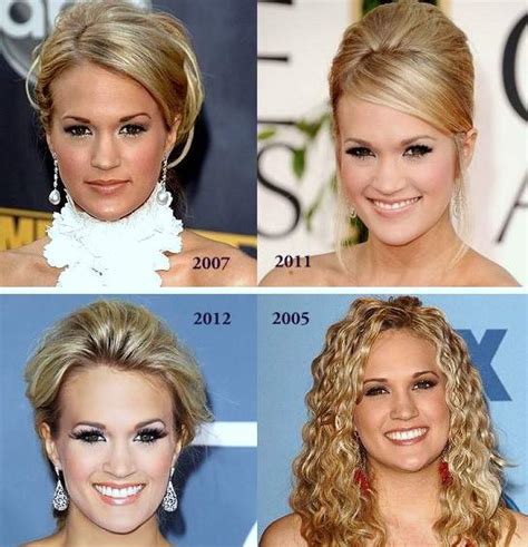Carrie Underwood Plastic Surgery Before And After Photos Celeblenscom