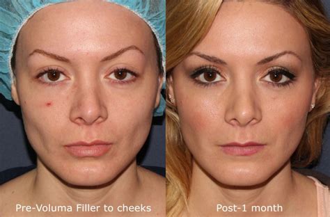 9 Essential Questions To Ask If Youre Considering Facial Fillers