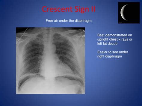 Ppt Abdominal X Ray Radiological Signs Powerpoint Presentation Free