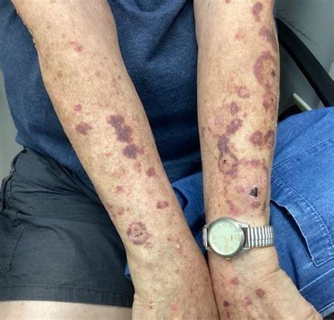 Dermdx Bruising On Arms In Older Patient Clinical Advisor