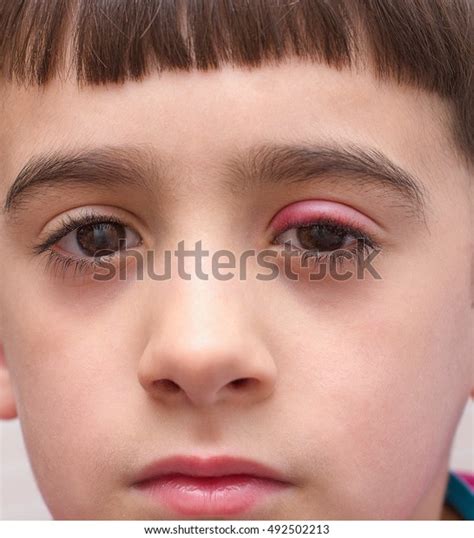 Stye Upper Eyelid Inflammation Stock Photo 492502213 Shutterstock